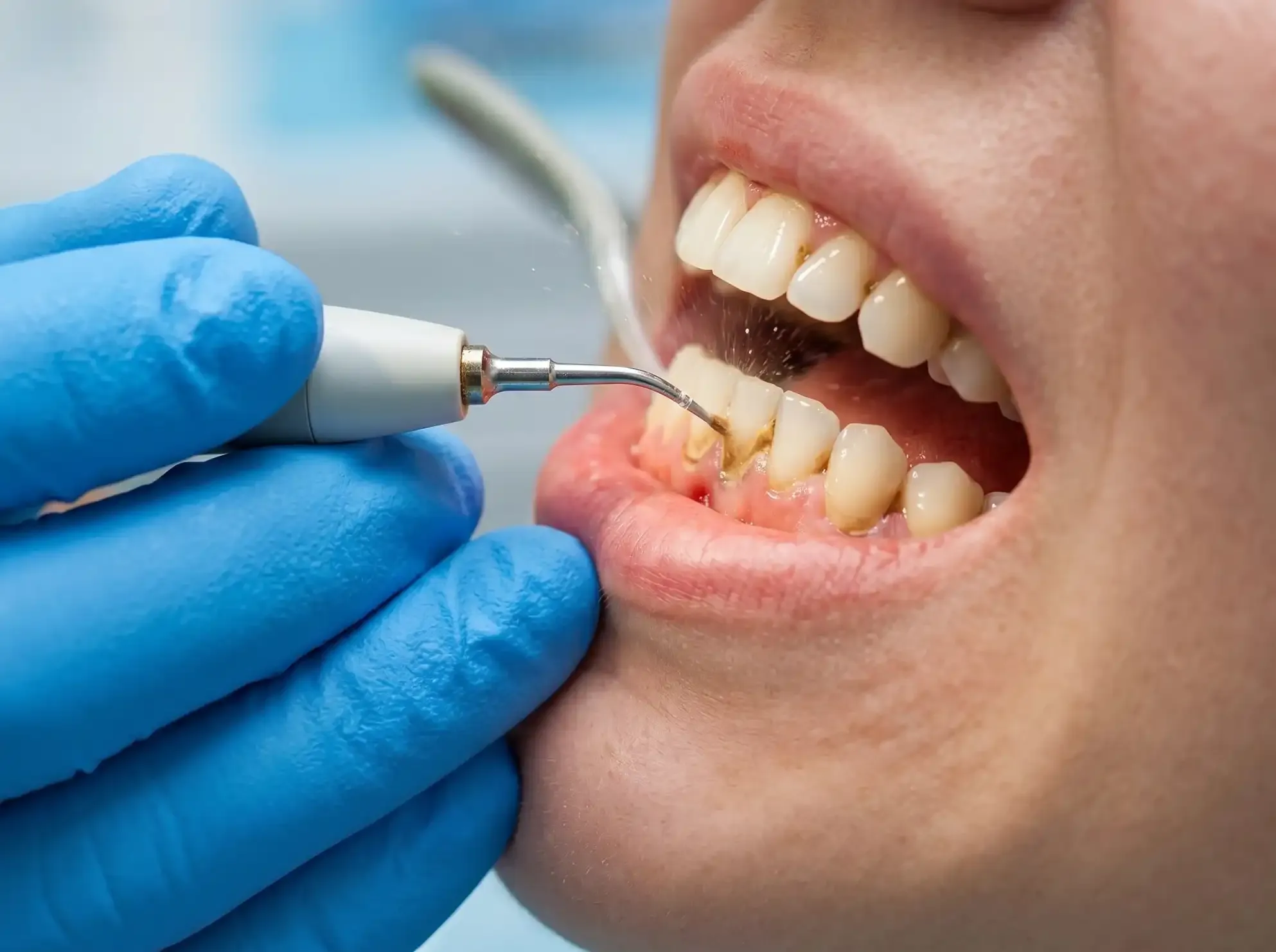 Periodoncia